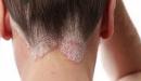 افضل علاج لصدفية الراس