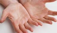 علاج تعرق اليدين