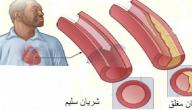 اعراض تصلب الشراين اعراض تصلب الشراين