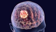اعراض مرض الورم فى المخ