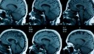 اعراض شلل الدماغ عند الاطفال اعراض شلل الدماغ عند الاطفال