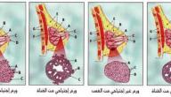 ورم خبيث في الثدي