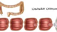 مضاعفات سرطان القولون مضاعفات سرطان القولون