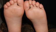 التخلص من تشقق القدمين في يومين