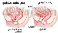 اعراض نزول الارحام