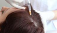 علاج الميزوثيرابي للشعر