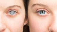 الماء الزرقاء في العين وعلاجها
