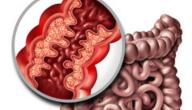 ما أسباب انسداد الأمعاء؟