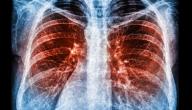 من يجب أن يقوم بفحص سرطان الرئة؟