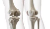 ما المقصود بقطع عظام الركبة؟