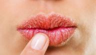 علاج الشفاه المتشققة في المنزل