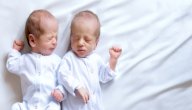الحمل بتوأم في كيس واحد ومشيمة واحدة: هل يمكن ذلك؟