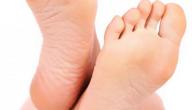 ما هو علاج تشقق القدمين