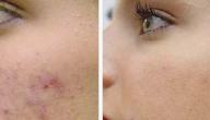 علاج اثار حب الشباب والحفر