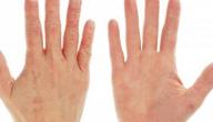 ما هو علاج جفاف اليدين