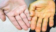 ما سبب اصفرار الجسم ما سبب اصفرار الجسم