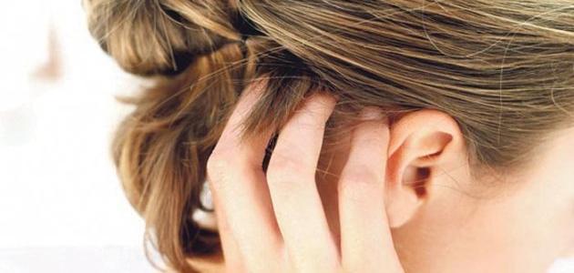 التهاب فروة الراس وتساقط الشعر