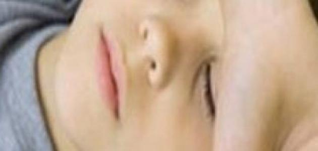 أعراض فقر الدم عند الأطفال