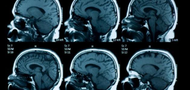 اعراض شلل الدماغ عند الاطفال