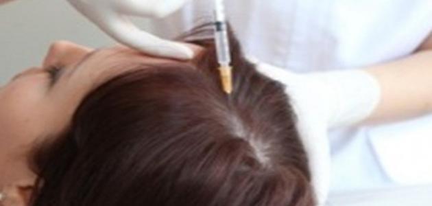علاج الميزوثيرابي للشعر