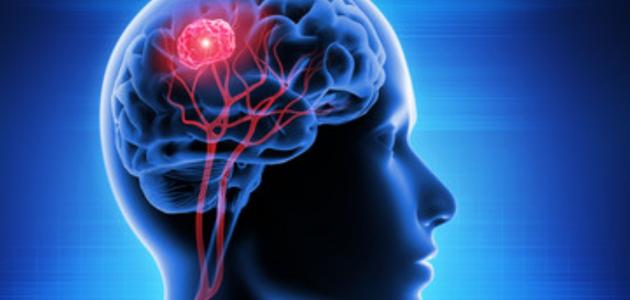ما هي أعراض ورم الدماغ الكاذب؟