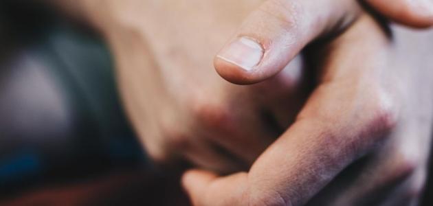 صدفية الأظافر: كيف أتخلص منها؟