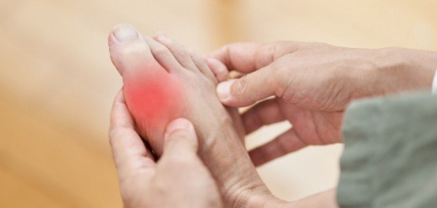 أعراض ارتفاع اليوريك أسيد