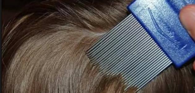 علاج القمل