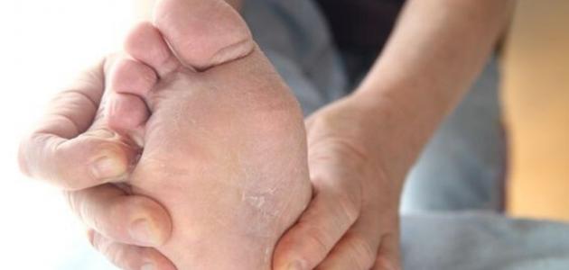 علاج فطريات القدم بالثوم