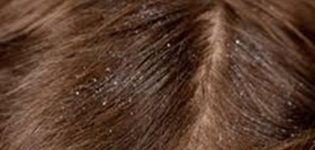 افضل علاج للقشره