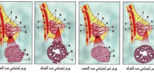 سرطان الثدي الخبيث