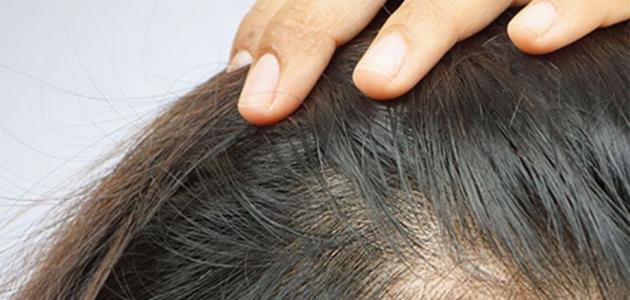 علاج تساقط الشعر بالليزر