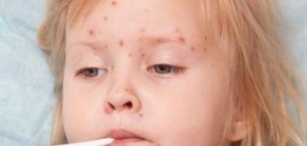 ما علاج العنقز